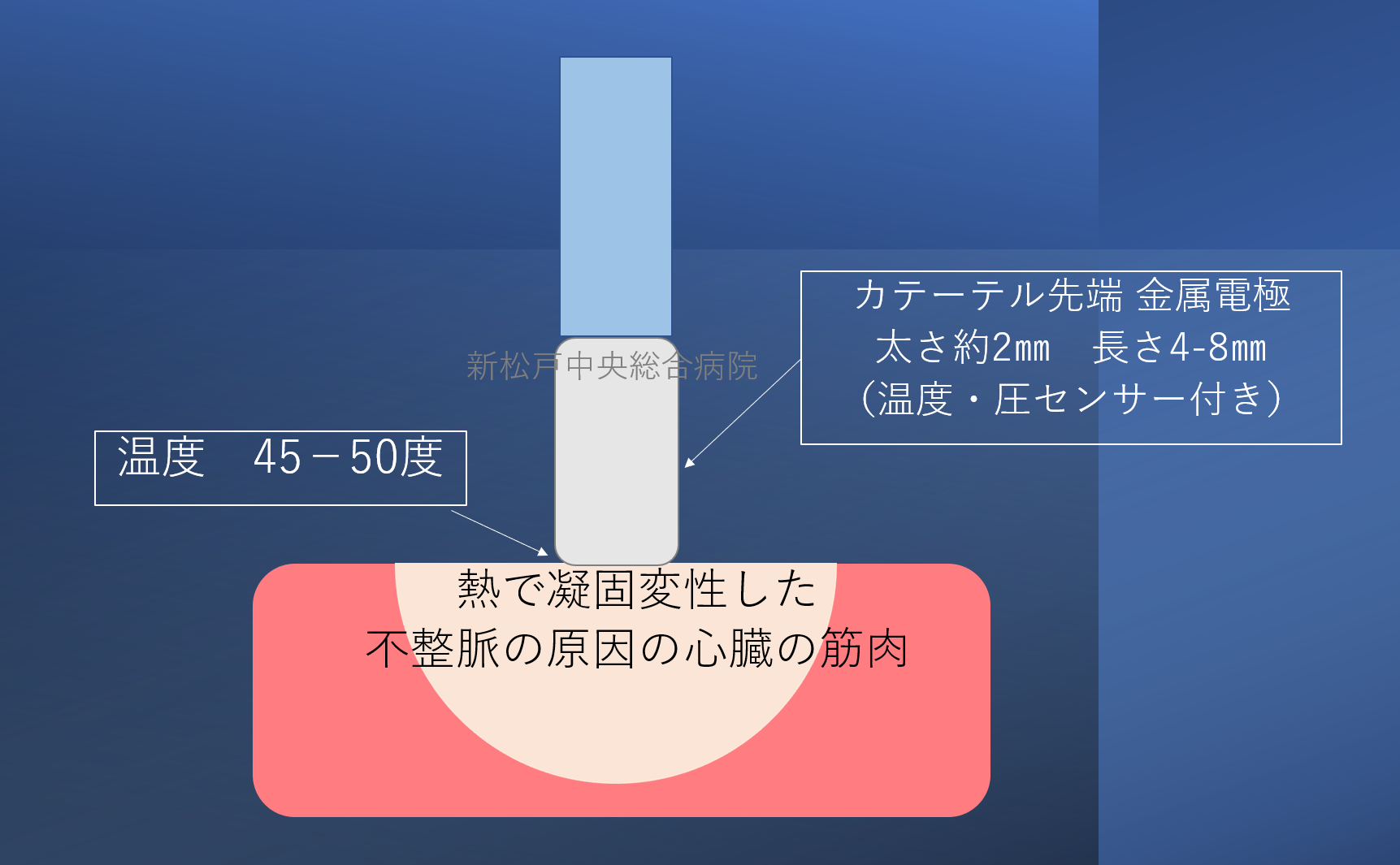 カテーテルアブレーション１