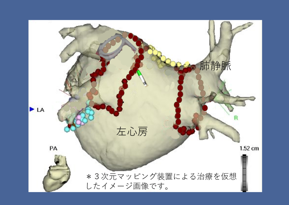 カテーテルアブレーション5