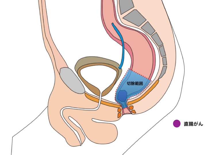 図４ 内肛門括約筋切除術（ISR）
