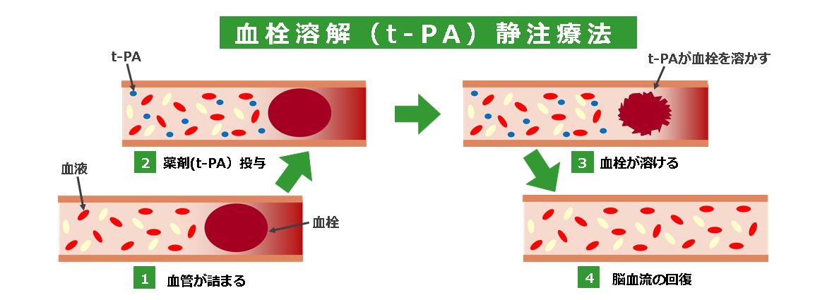 t-PA療法