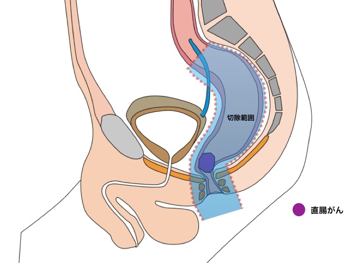図３ 直腸切断術