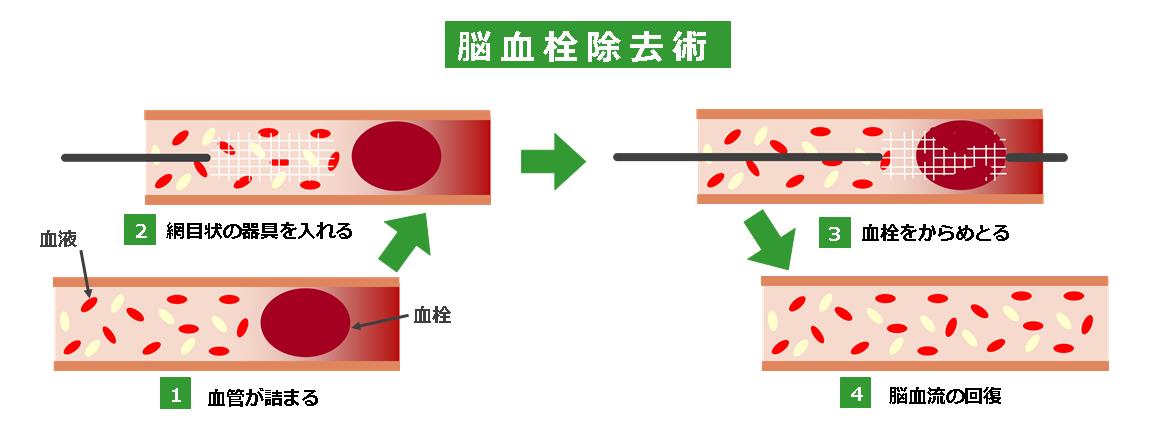 脳血栓除去術