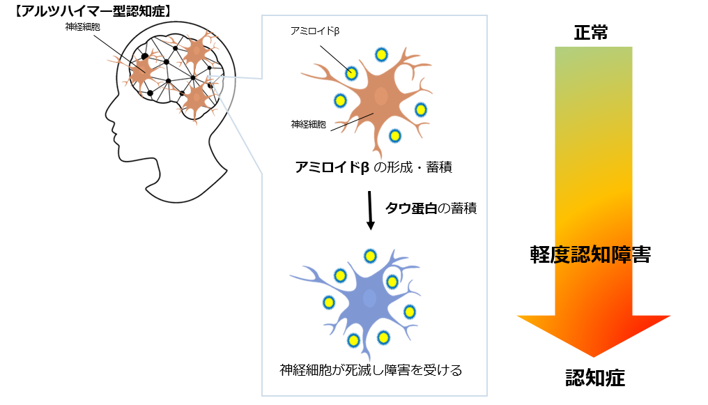 アルツハイマー型認知症