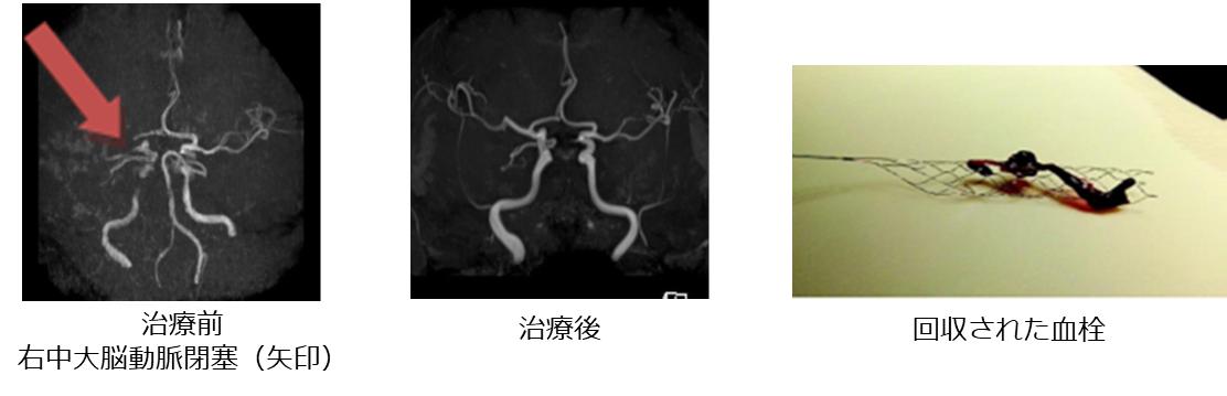 脳血栓除去術(治療前後）