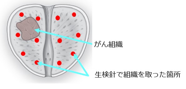 前立腺生検と MRI の比較