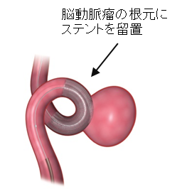 脳動脈瘤の根元にステントを留置