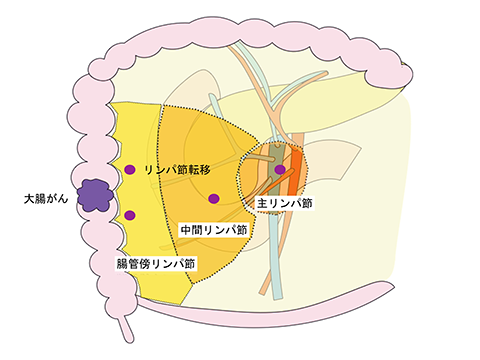 図１ リンパ節郭清の一例（上行結腸がん）