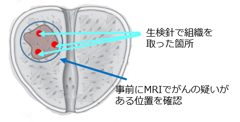 経会陰的前立腺生検の手順は何ですか?